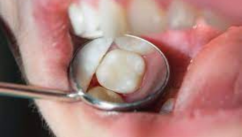 Restorative Dentistry in Surfside, FL