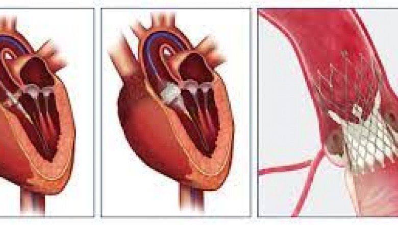 Transcatheter Heart Valve Replacement is a minimally invasive procedure for replacing a narrowed aortic valve that is unable to open properly.