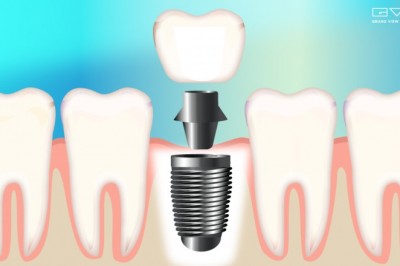Dental Implant Market Size Worth $8.0 Billion By 2028