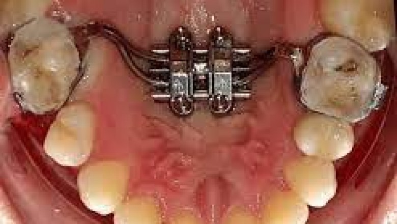 Reasons Why Distraction Osteogenesis Devices Is Getting More Popular In The Past Decade.