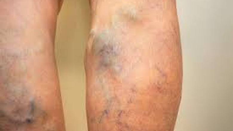 varicose vein treatment near me