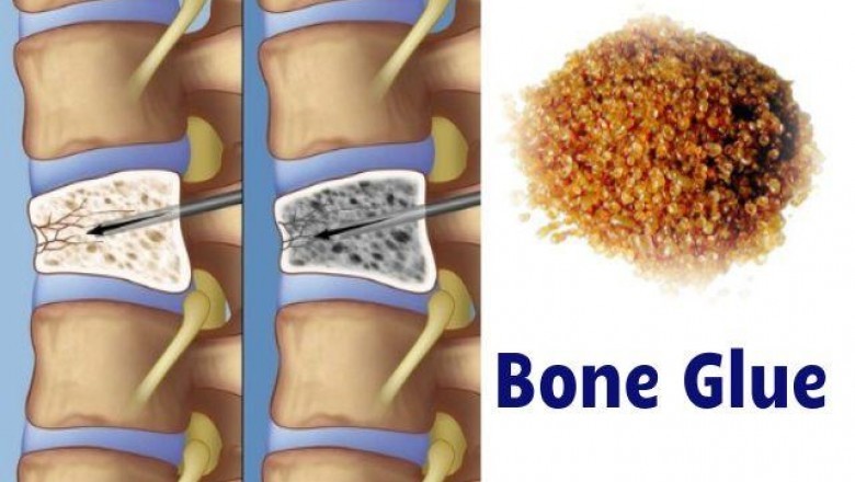 Bone Glue is used to join bone fractures and is used by many orthopedists throughout the world. It has been proven to be quite effective.