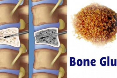 Bone Glue is used to join bone fractures and is used by many orthopedists throughout the world. It has been proven to be quite effective.