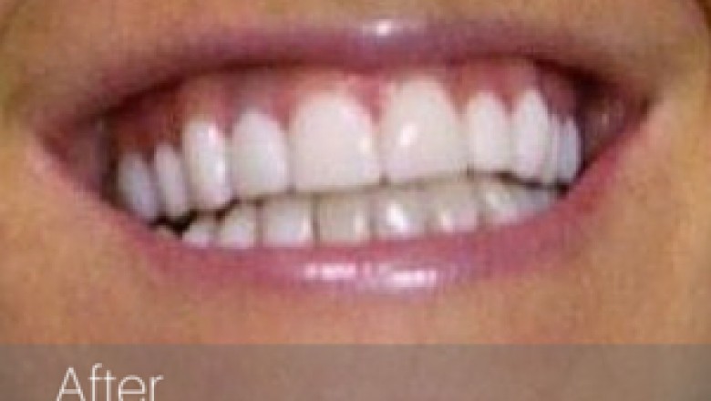 Teeth whitening - Beyond Beauty