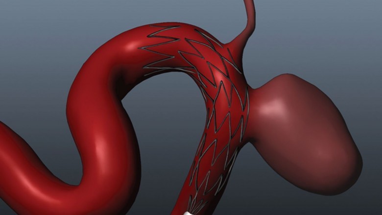 What will the Intracranial Stents Market size be in 2022 and what will the growth rate be?