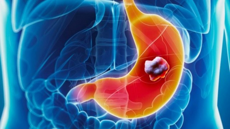 Treatment of gastric cancer depends on type and stage of cancer, possible side effects, patients' preferences, and overall health.