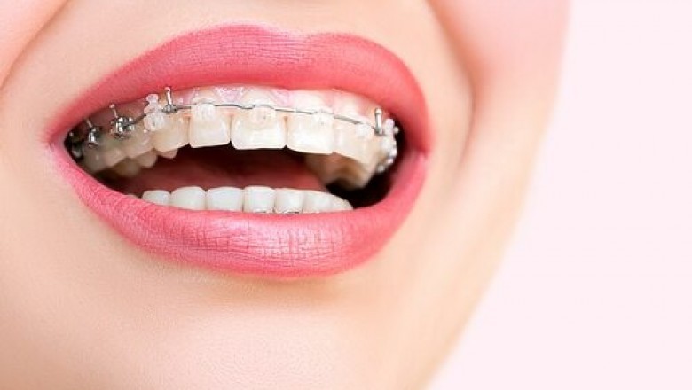 BRACES and Youngsters ORTHODONTICS | Luminous Dental Group