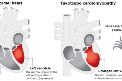 Emerging Trends in Takotsubo Cardiomyopathy Market 2018 and Global Foreseen Till 2028 | Top Key Vendors – GSK, Sun Pharma, Teva, Sanofi, Pfizer