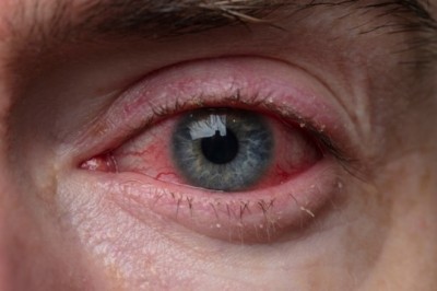 Blepharitis Treatment Market | Trends,Size, Growth, Share, COVID-19 Impact ...