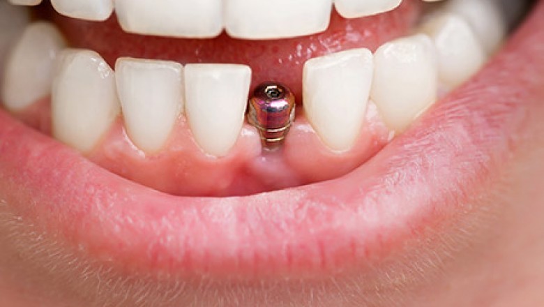 What Are Dental Implants?