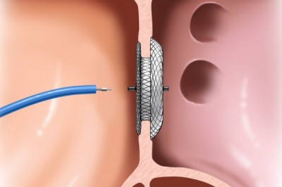 Who are the top players that are involved in manufacture of Patent Foramen Ovale (PFO) Closure Devices Market ?