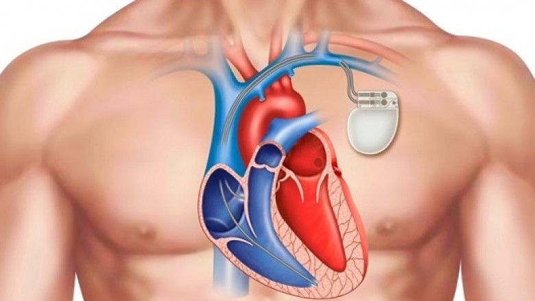 Cardiac Pacemakers Market: Know about Impact of Covid-19 by Top Companies like – GE, Medtronic, Abbott