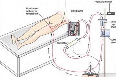 Comprehensive Study on Continuous Renal Replacement Therapy Market 2021-2028: Business Opportunity and Recent Development Analysis by Baxter, B. Braun, Medtronic