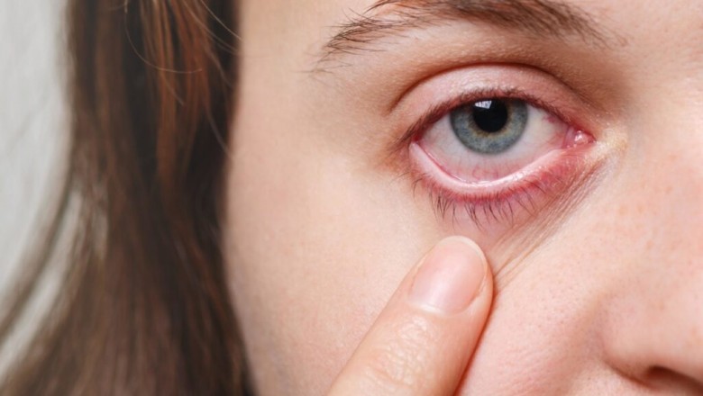 Red Eyes – Causes, Symptoms, Treatment and Prevention