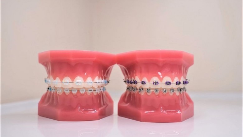 Smile Confidently With Invisalign Braces: