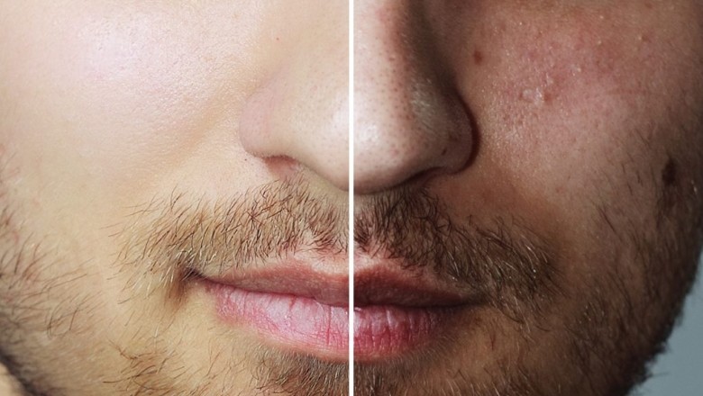 Five Benefits Of IV Hydration Therapy: