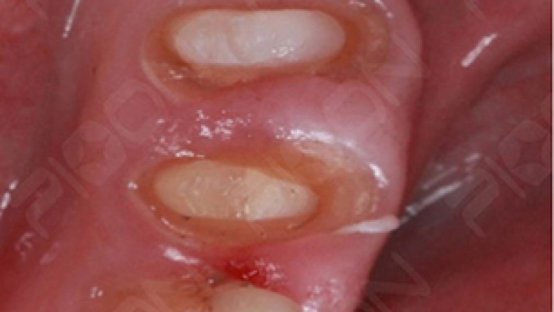 Management of Gingival Tissue - Gingival Troughing using Diode Laser