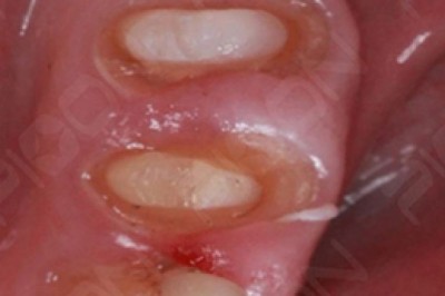 Management of Gingival Tissue - Gingival Troughing using Diode Laser