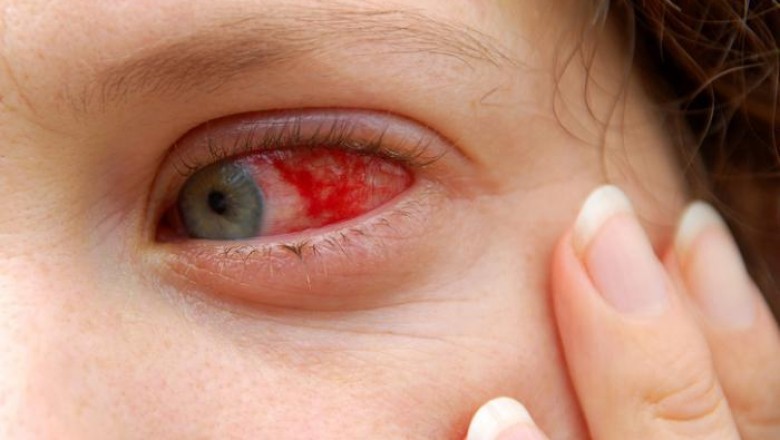 The Uveitis Treatment Market With Major Key Players AbbVie, Novartis AG, Eyegate Pharmaceuticals, Santen Pharmaceuticals, and Allergan
