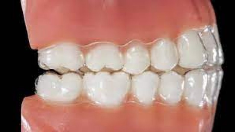How To Get A Dazzling Smile With Invisalign?