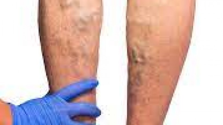 Varicose Veins And Endovenous Ablation