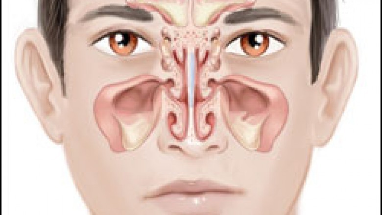 How Chronic Sinusitis Affects Quality Of Life And The Role Of Sinus Surgery