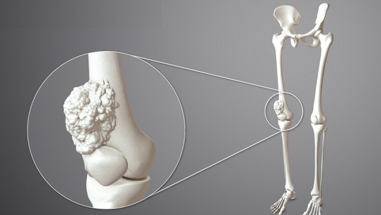 Bone Cancer Drug Market 2021: Upcoming Trends, Demand, Regional Analysis and Forecast To 2028