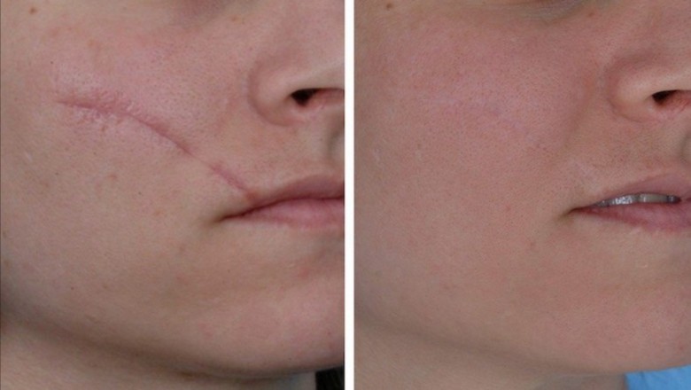 North America Scar Treatments are administered to patients who have acne or wound scars on their bodies or faces