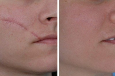 North America Scar Treatments are administered to patients who have acne or wound scars on their bodies or faces