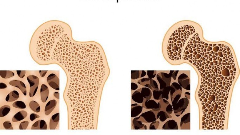 Erectiestoornissen: Hoe osteoporose leidt tot erectiestoornissen bij mannen