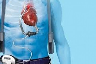 Growth in Sales of Cardiac Assist Devices Market to Push Revenue Growth in the Market