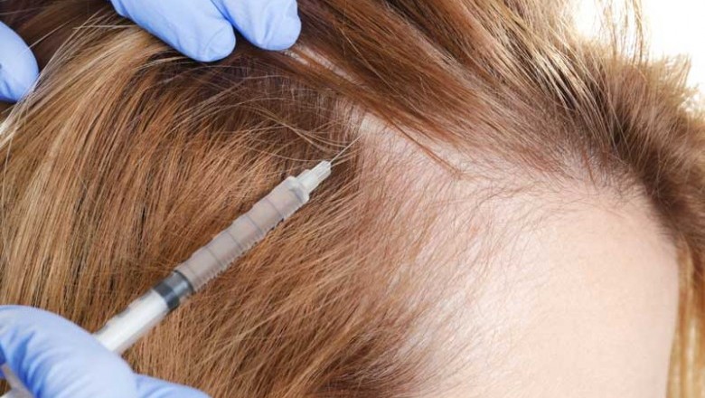 The Number Of People Seeking Hair Loss Treatments Has Increased Because Of Sedentary Lifestyles, Unhealthy Eating Habits, And Increasing Stress Levels