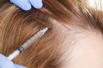 The Number Of People Seeking Hair Loss Treatments Has Increased Because Of Sedentary Lifestyles, Unhealthy Eating Habits, And Increasing Stress Levels