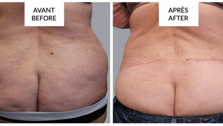 Plastic Surgery in Montreal