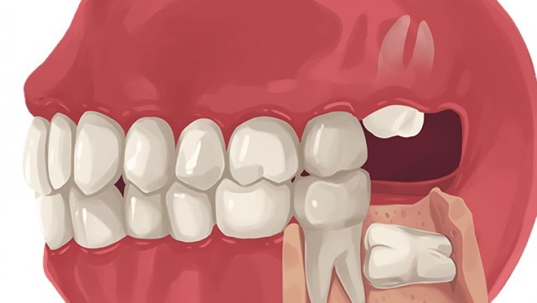 Five Tips To Prevent Gum Disease:
