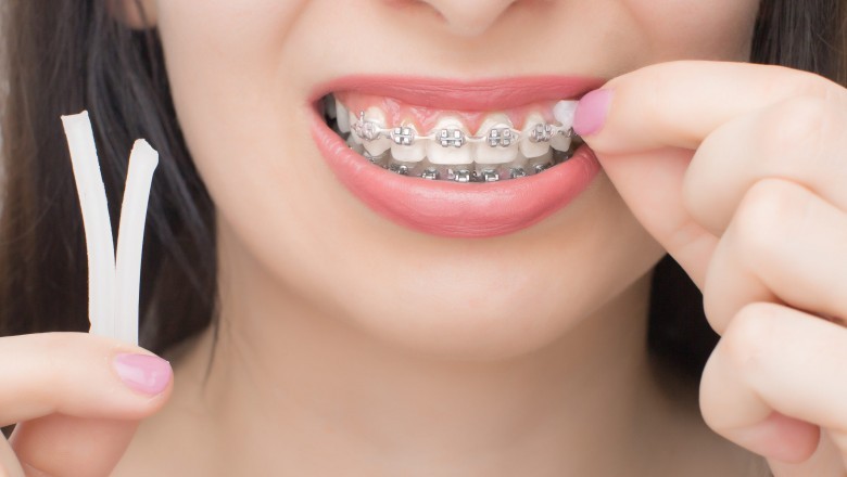 Orthodontic Supplies used to keep children straight and healthy teeth for a longer period of time include orthodontic bands, orthodontic headgear and orthodontic headboards