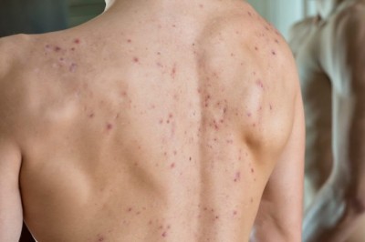 7 Hacks To Get Rid Of Back Acne Naturally!