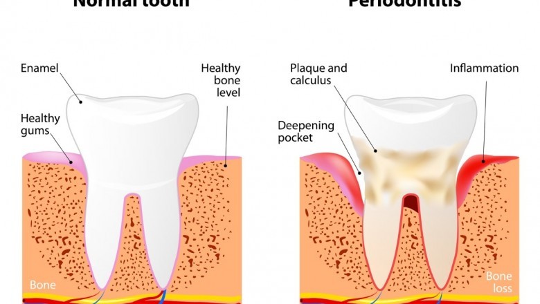 How to Find a Full Mouth Restoration Dentist?