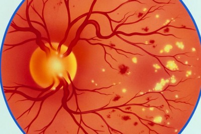 Impact of COVID-19 Pandemic On Diabetic Retinopathy Treatment Market | Growth By Top Company, Region, Applications, Drivers, Trends & Forecast to 2027 | CAGR of 11.9% | Ampio Pharmaceuticals (U.S.), Novartis AG (Germany)