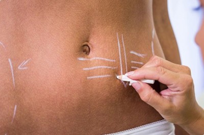 LipoSuction Surgery In Trichy