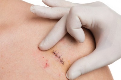 Skin Biopsy Market Growth, Trends, Demand, Industry Analysis, Key Player profile and Regional Outlook by 2027 | COOK Medical (U.S.), Devicor Medical Products, Inc. DTR Medical Ltd (U.K), Gallini Srl (Italy), Hologic, Inc.