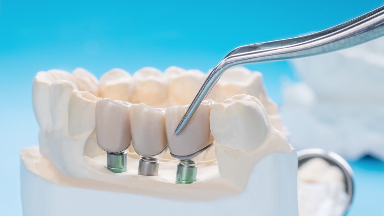 Zirconia Crowns In Mohali