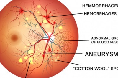 Diabetic Retinopathy Market Upcoming Trends, On-Going Demand, Growth and Forecast from 2021 to 2027 | Sirnaomics (U.S.), Actavis Plc (U.K.), Regeneron Pharmaceuticals Inc. (U.S.), ThromboGenics
