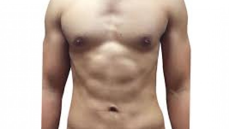 Laser Liposuction: Everything You Need To Know About!