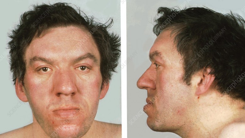 Acromegaly Market Growth, Share, Demand and Applications Forecast 2027 | Opportunity, Competitive Scenario, Recent Developments