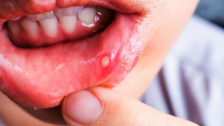 Disease Of Mouth - Herbal Remedies For Mouth Ulcers