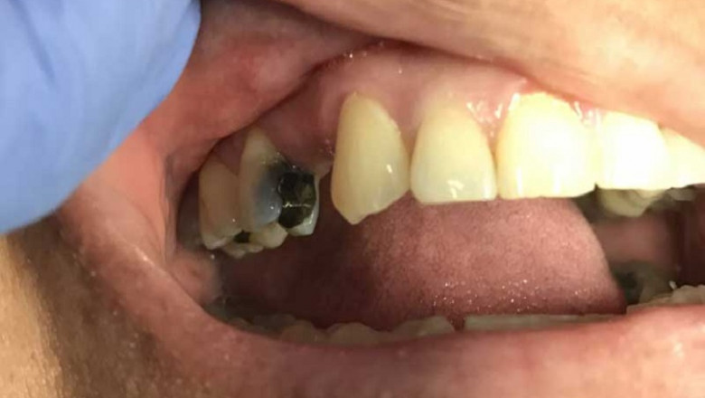 Gingivitis Treatment