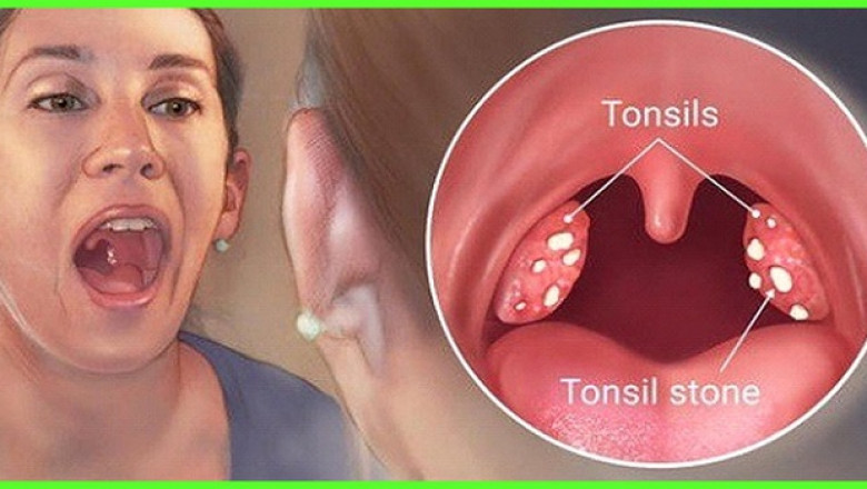 Herbal Remedies For Sore Throat - Best Herbal Medicine For Sore Throat
