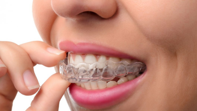 What Is the Process of Wisdom Teeth And How To Get It Correct?