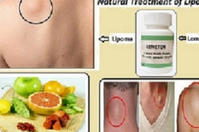 Lemeton Herbal Supplement for Natural Treatment of Lipoma